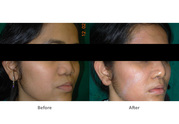 Reliable resource for the safest Rhinoplasty in India