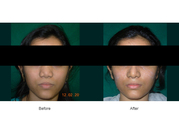 Professional  resource for Rhinoplasty surgery in India