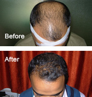 Hair Transplant Surgery by Cutis Cosmetic in Ahmedabad 	