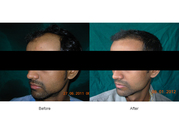 Hair Transplant Surgery in Ahmedabad
