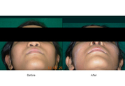 Best Nose Surgery Clinic in Ahmedabad