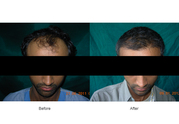 Solve your Baldness problem with Hair Transplantation  surgery