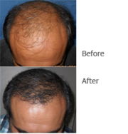 Hair Transplant surgery  - Permanent Solution of your hair loss proble