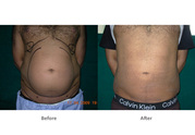 Slimmer Look with Liposuction Surgery 