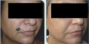 Remove mole by surgical treatments and enhance your facial appearance