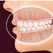 Best Dental Implants clinic in Ahmedabad - 32 Pearls Dental