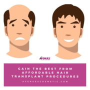 Gain The Best From Affordable Hair Transplant Procedures