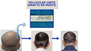 Cost of Fut Hair Transplant in India