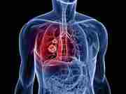 lung cancer breakthroughs: Revolutionary Breakthroughs in Lung Cancer 