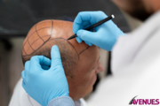 FUE Hair Transplant Cost in Ahmedabad,  India