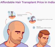 Affordable Hair Transplant Price in India 