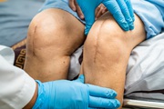 Best Knee Replacement Surgeon in Ahmedabad