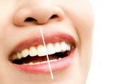 Teeth Whitening at Discounted Rates – Limited Time in Ahmedabad!