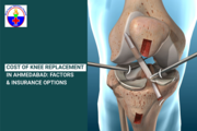 Are you looking for the cost of knee replacement in Ahmedabad?