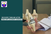 Recovery Timeline After Knee Replacement Surgery: Step-by-Step Guide